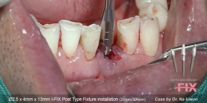 #31 immediate implant placement & loading with I-FIX 관련사진
