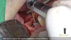 Immediate implant with SAVE SEPTUM DRILL KIT 관련사진