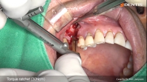 Mx posterior implant placement with lateral sinus lift and bone graft 관련사진