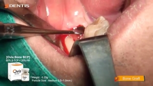Posterior Mandibula Implant Installation Single Case 관련사진