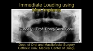 Immediate Loading using Mini Implant 관련사진