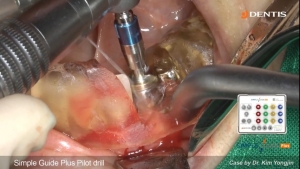 #34 Implant placement with SIMPLE GUIDE Plus & GBR 관련사진