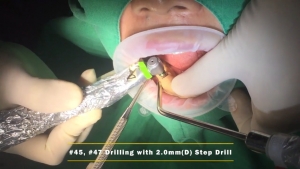 #45, #47 Implant Placement with SIMPLE GUIDE Plus 관련사진