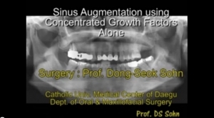 Sinus Augmentation using Concentrated Growth Factors Alone 관련사진