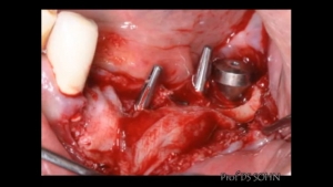 Immediate Loading using Mini Implant (Dentis Co.) 관련사진