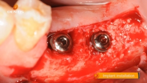 Posterior Mandibula Case (#36, #37 OneQ-SL Implant) 관련사진