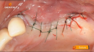 Posterior Maxilla Case (#25, #26 Dentis Cleanlant Implant) 관련사진