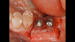 Louis Button - the Easiest and Safest way to increase Attached-gingiva 관련사진