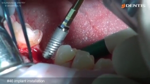 Video Manual of Single Implant Surgery with Cleanlant 관련사진