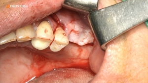 Posterior Maxilla Case after Sinus Lift Lateral Window Surgery 관련사진