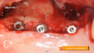 Posterior Maxilla Case (#15 #17 OneQ SL Implant) 관련사진