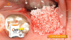 Posterior Mandibula (#37, Dentis OneQ-SL Implant, Ovis HA Bone) 관련사진