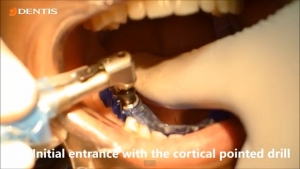Mandibular Implant Installation using Simple Guide (#45, #46 Cleanlant) 관련사진