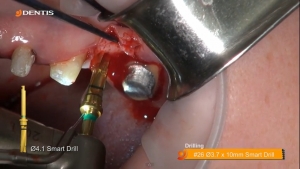 Safe Bicortical Implant Installation at #26 관련사진