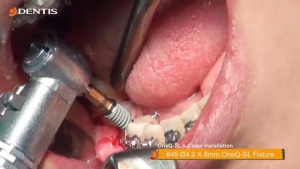 Mandibula Implant Installation with GBR 관련사진