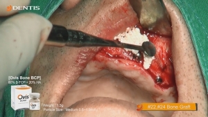 Maxillary Bone Grafting with Immediate Implant Installation 관련사진