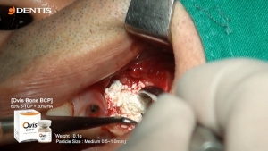 Bone Grafting after Removal Implant Fixture 관련사진