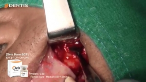 Sinus Lift Bone Grafting after Removal Implant Fixture 관련사진