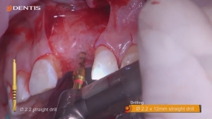 Implant Placement with GBR Procedure 관련사진