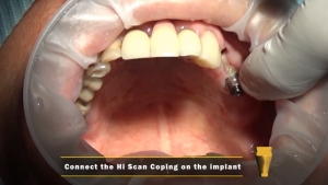 How to use of HI SCAN Coping 관련사진