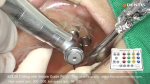Maxillary Implant Installation through SIMPLE GUIDE Plus 관련사진