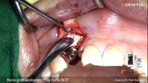 Ridge splitting by mass and chlsel, bone graft(CGF), sling suture 관련사진