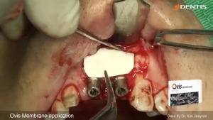 #21, #22 Immediate Implant Placement GBR 관련사진