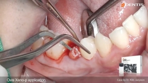 Lower premolar immediate implant placement & immediate loading 관련사진