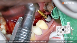 #36 immediate SQ implant placement using SAVE Septum drill 관련사진