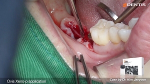 Low posterior implant placement and buccal GBR 관련사진