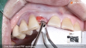 Upper anterior immediate implant placement & loading with SQ fixture 관련사진