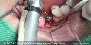 Posterior Mn simple implant surgery 관련사진