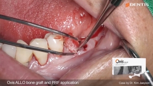 MN posterior immediate implant placement and bone graft 관련사진