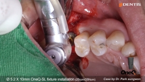 #16 Implant Placement with OneQ-SL fixture 관련사진