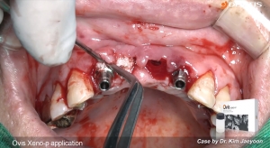 Upper anterior immediate implants placement and loading with socket preservation 관련사진