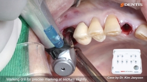 Upper posterior immediate implant placement with SQ fixture 관련사진