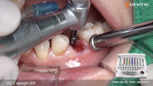 Mn premolar immediate placement with SEPTUM DRILL KIT 관련사진