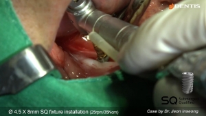 Screw removal and Implant placement 관련사진
