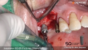 Upper posterior implant placement with crestal sinus lift 관련사진