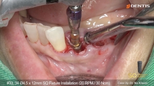 Immediate implant placement with Guide Wheel and Impression with Multi Use Coping 관련사진