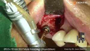 Fixture removal and Implant placement 관련사진