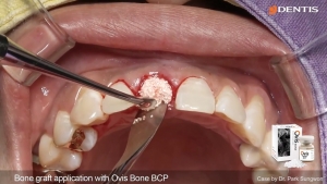 #11 Extraction and immediate installation with immediate loading, bone graft, CGF 관련사진