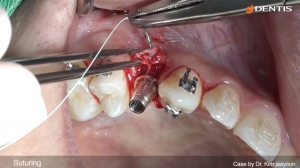 Upper premolar simple implant placement and immediate loading 관련사진