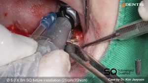 Posterior Mn implant surgery with SIMPLE GUIDE Plus and SQ fixture 관련사진