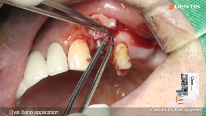 #24 implant placement with buccal GBR 관련사진