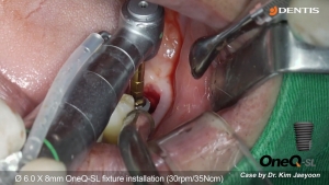 #37 immediate implant placement with bone graft 관련사진