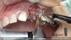Upper premolars implant placement with SQ fixture 관련사진