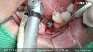 Posterior Mn simple implant surgery 관련사진