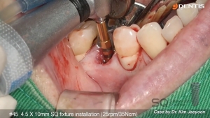 Lower premolar area immediate implant placement with SQ fixture 관련사진