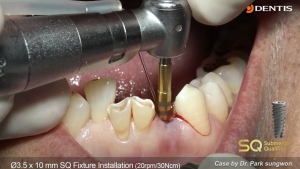 Immediate Implant placement after extraction and immediate loading 관련사진